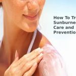 How To Treat Sunburned Skin - Care and Prevention
