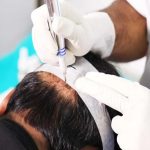 Scalp Micropigmentation treatment