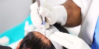 What to Expect from Scalp Micropigmentation treatment? Scalp Micropigmentation treatment