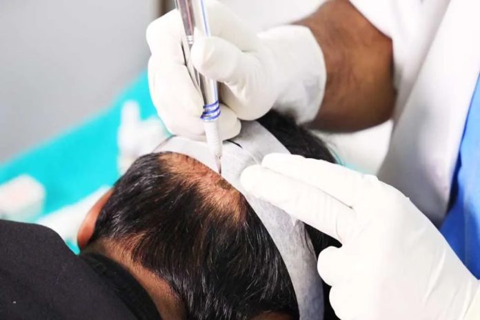 Scalp Micropigmentation treatment