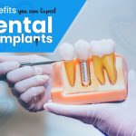 Top 8 Benefits You Can Expect From Dental Implants Dental Implants
