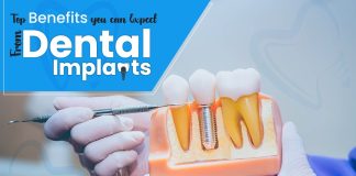 Top 8 Benefits You Can Expect From Dental Implants Dental Implants