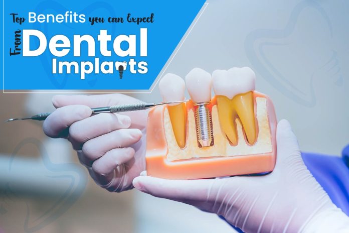 Dental Implants