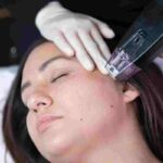 What You Need to Know About Morpheus8 Treatment? morpheus8 treatment