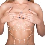 Breast lift surgery