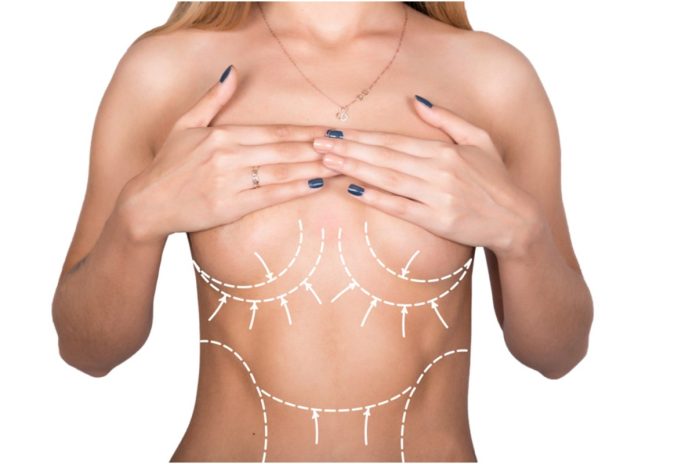 Breast lift surgery