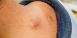 How Do you Get Rid of a Cyst on your Hand? Cysts