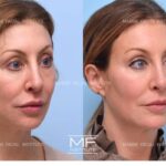 Tear Trough Fillers Explained: What You Need to Know tear trough fillers