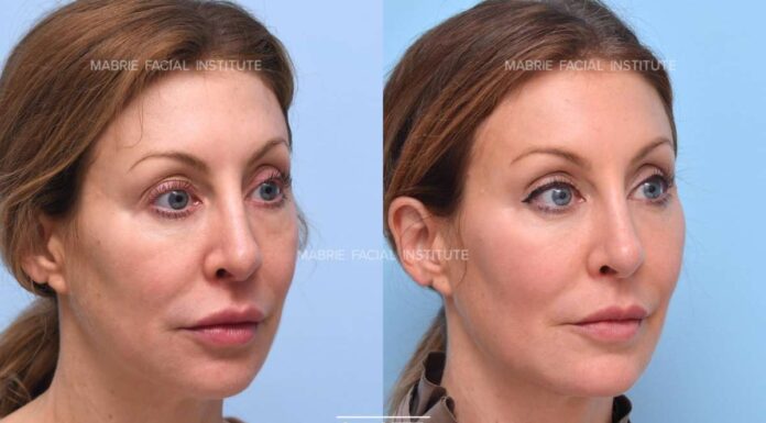 Tear Trough Fillers Explained: What You Need to Know tear trough fillers