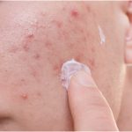 Get rid of acne