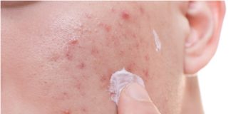 How to Get Rid of Acne: 5 Quick Tips Get rid of acne