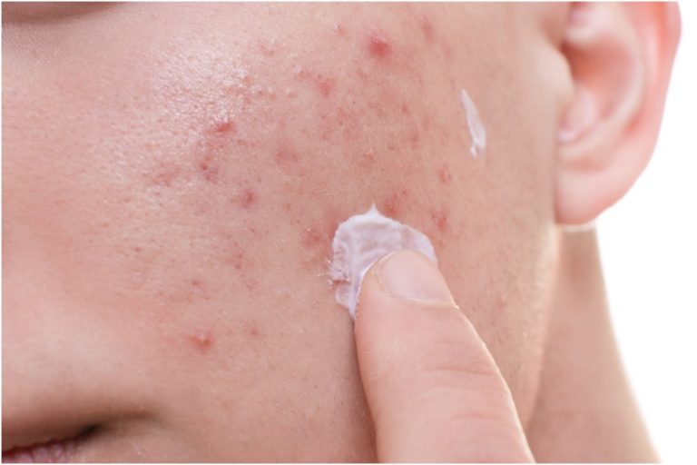 How to Get Rid of Acne: 5 Quick Tips
