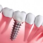 Dental Implants Recovery: What to Expect and How to Prepare dental implants