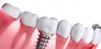 Dental Implants Recovery: What to Expect and How to Prepare dental implants