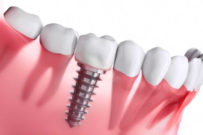 dental implants dental implants