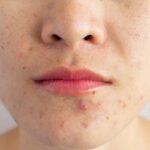 How to Get Rid of Acne: 5 Quick Tips how to get rid of acne