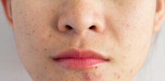 How to Get Rid of Acne: 5 Quick Tips how to get rid of acne