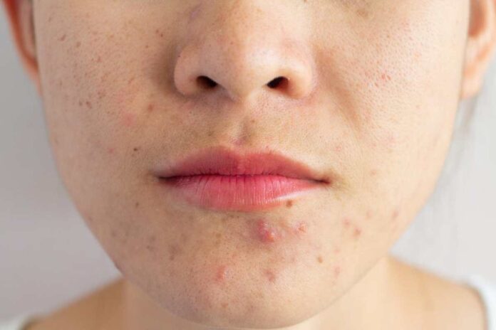 how to get rid of acne how to get rid of acne