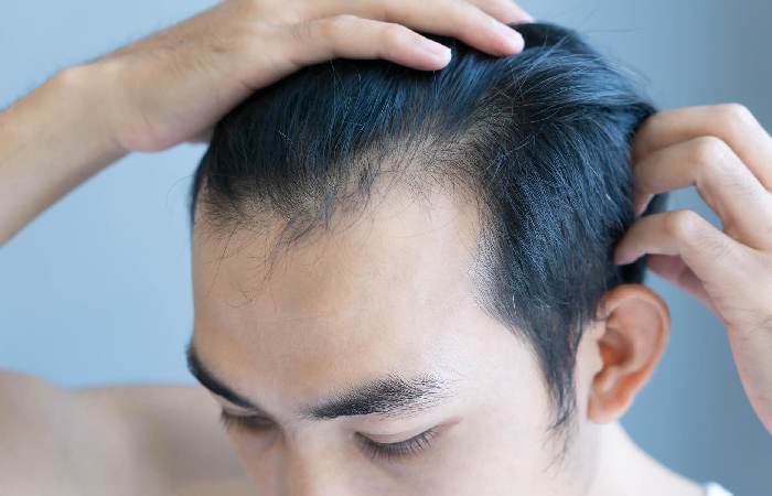 The Psychological Impact of Hairlines